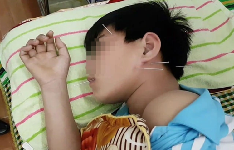 Điện châm điều trị phục hồi chứng năng vận động ở trẻ bại não (Ngũ trì)